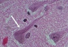 Neurofibrillary Tangles (Alzheimer's <br>Disease) and Pick Bodies